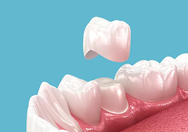 Dental crown about to be placed onto a tooth.